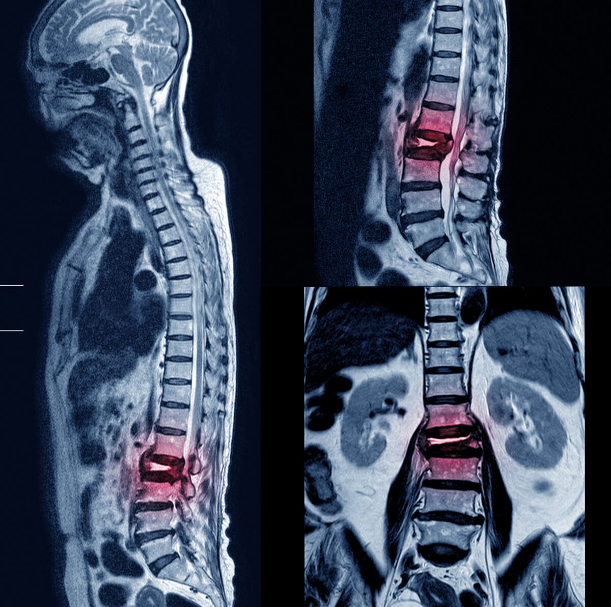 Spine & Head/Neck Injuries Gymnastics Medicine